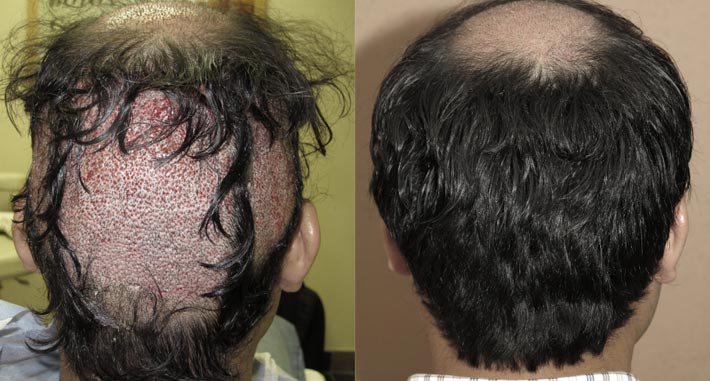 stop hair loss and regrow hair